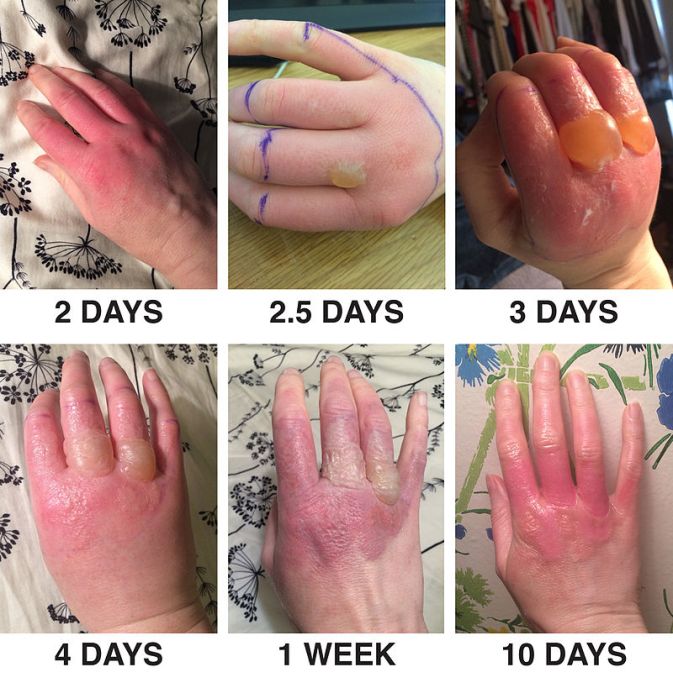 Phytophotodermatitis_from_exposure_to_lime_juice